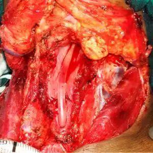 咽壁癌图片