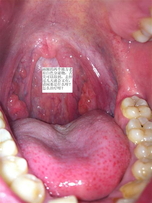正常咽喉后壁图片,正常人的喉咙图片