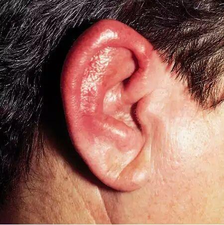 耳朵疖肿最快消除办法图片