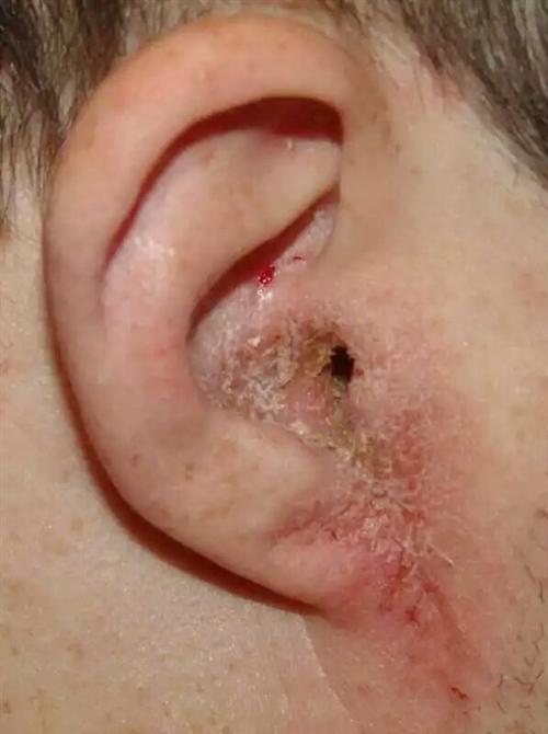 外耳道疱疹图片图片