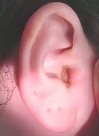 外耳道肉芽肿图片图片