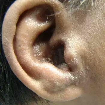 外耳道疖肿切开排脓图片