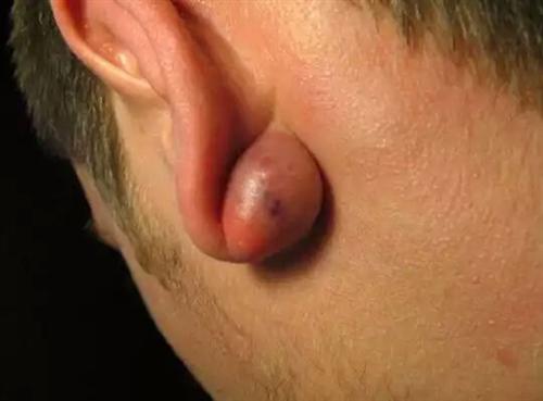 外耳道长了个疙瘩图片