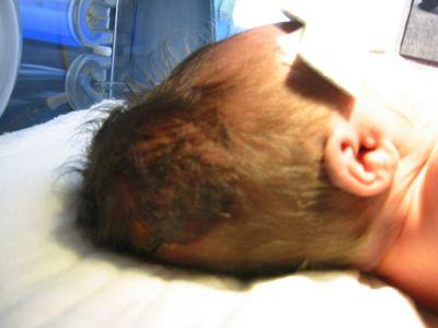 婴儿头上有血肿的图片图片