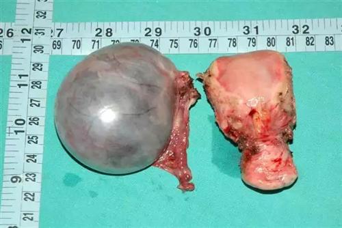 子宫囊腺瘤图片