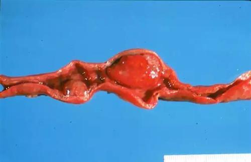 子宫息肉掉出来的图片图片