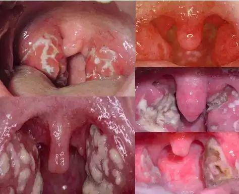 咽喉炎有哪些症状图片图片