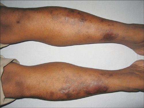 慢性肢端皮炎图片