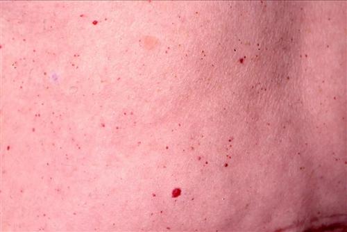 樱桃血管瘤 早期图片