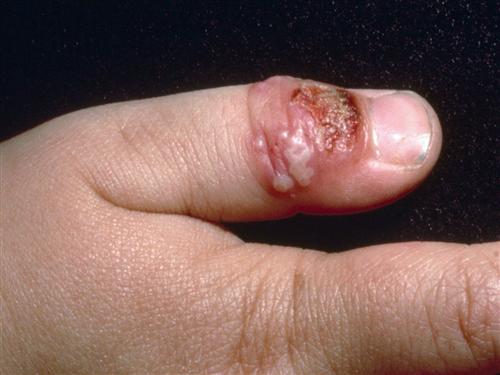 手指头炎的症状和图片图片