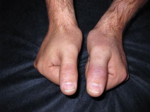 水疱性远端指炎