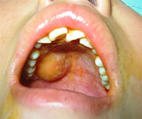 口腔唾液腺堵塞的图片图片