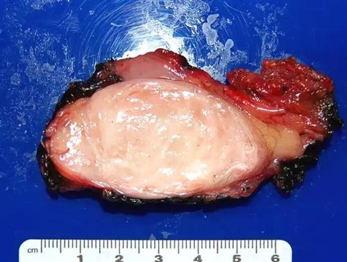 滑膜肉瘤晚期图片