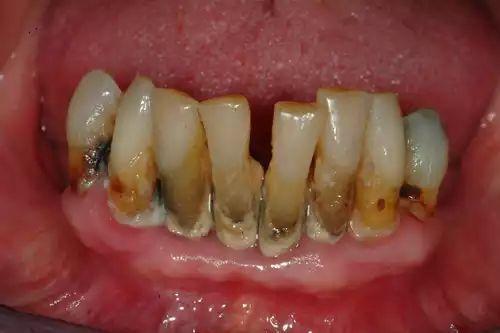 牙周病晚期图片
