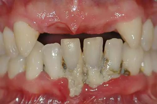 牙龈癌图片晚期 初期图片