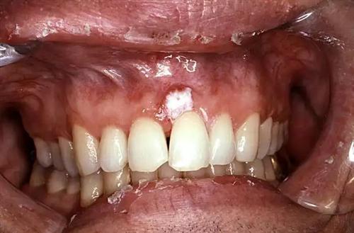 牙龈癌一般长在哪里图片