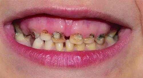 牙龈癌图片 晚期图片