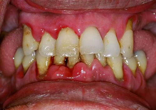 牙龈癌初期图片