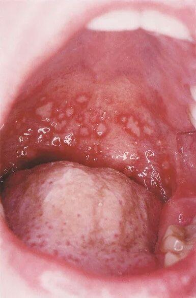 喉咙后咽壁有疱疹图片图片