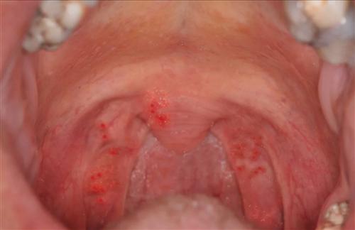 成人咽峡炎疱疹图片图片