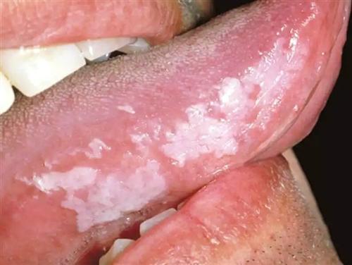 艾滋病舌毛状白斑照片图片