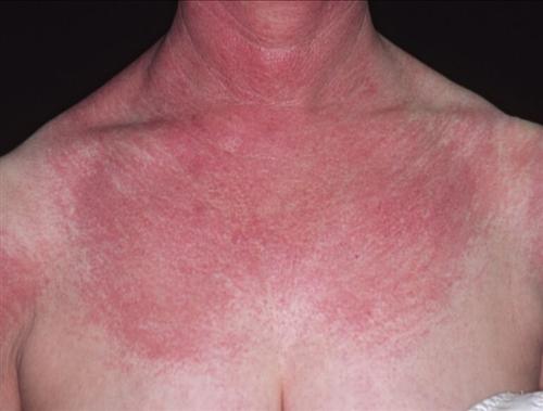 皮肌炎典型的皮疹图片图片