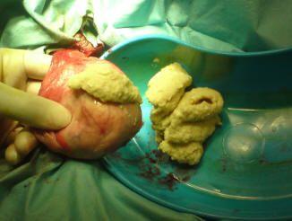 右侧睾丸附睾囊肿图片图片