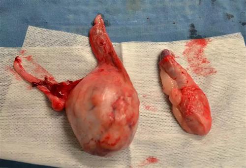 睾丸癌 早期图片