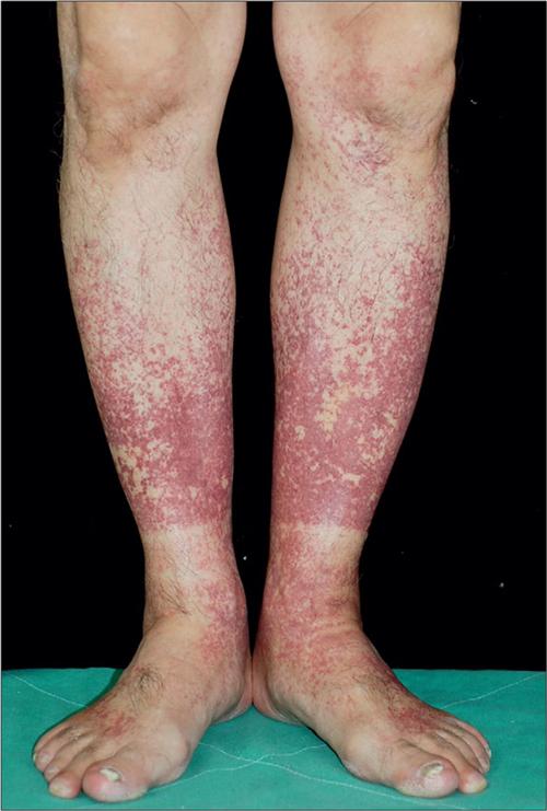 老年人过敏性紫癜