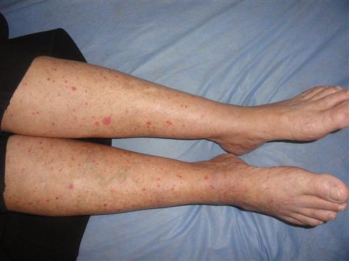 老年人过敏性紫癜