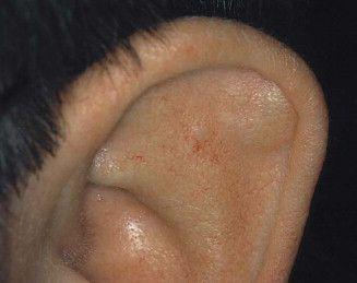 耳廓软骨瘤图片