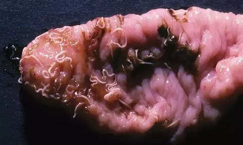 肠道蛔虫感染图片