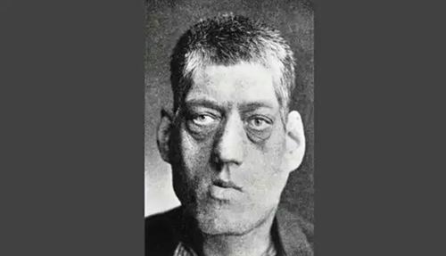 为什么会得肢端肥大症?