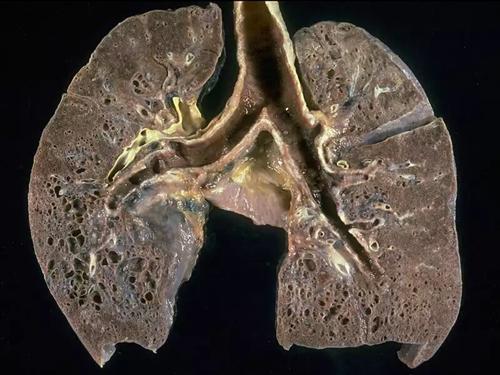 肺部纤维化什么样子图片