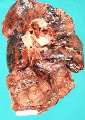 肺癌晚期肺部图片图片