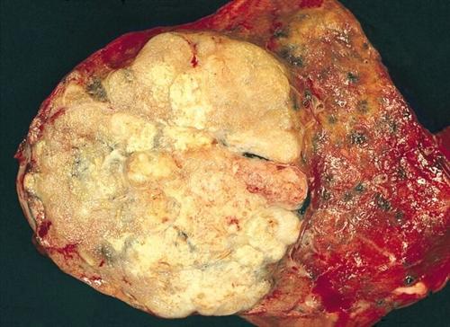 肺癌真实肿瘤图片图片