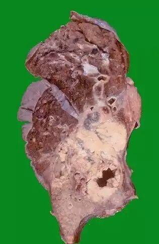 浸润性肺腺癌图片图片
