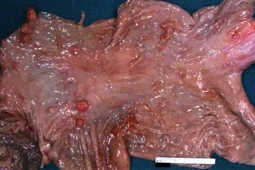 胃窦息肉图片图片