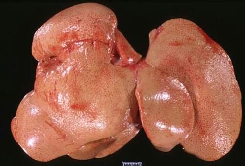 胃泌素瘤三角图片图片