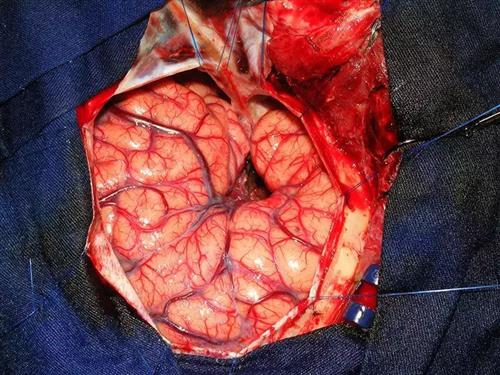 脑肿瘤真实图片