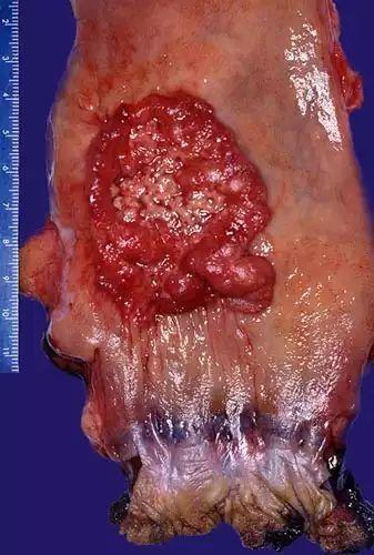 结肠中分化腺癌图片