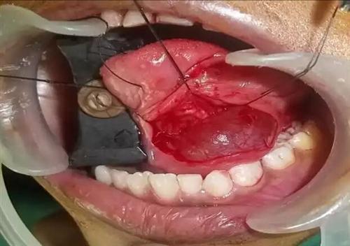 舌下腺囊肿治疗图片