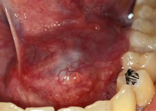 舌下腺癌图片 肿瘤图片