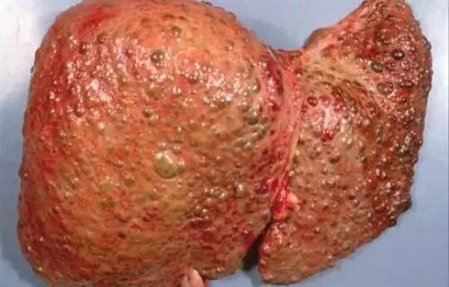 人体的脂肪肝真实图片图片