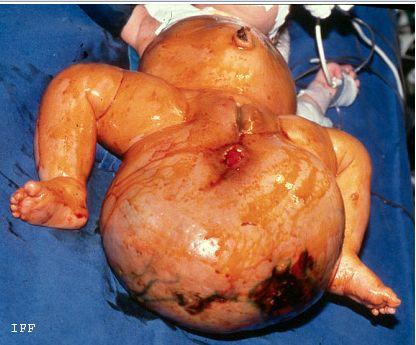 畸胎瘤症状图片