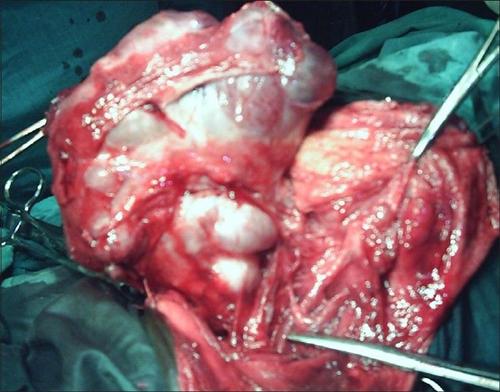 骶尾部畸胎瘤4型图片图片