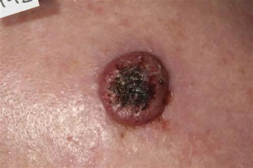 细胞癌早期症状图片图片