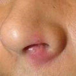 鼻疖肿鼻腔图片