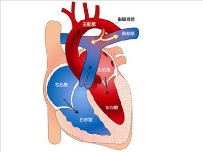 先天性肺动静脉瘘严重吗