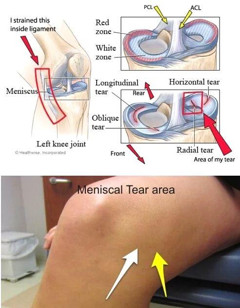 半月板损伤自我判断图图片